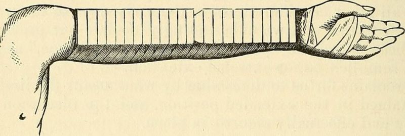 Image from page 323 of "A practical treatise on fractures and dislocations" (1871)