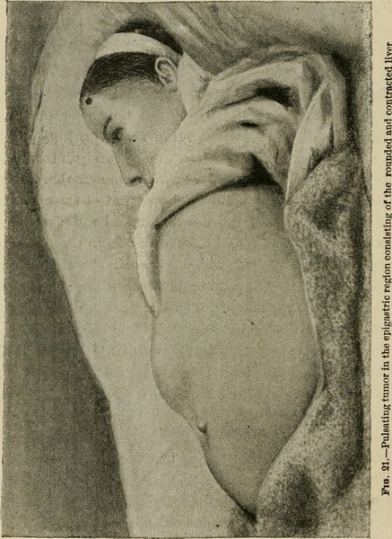 Image from page 79 of "Lectures on the diagnosis of abdominal tumors, delivered to the post-graduate class of Johns Hopkins university, 1893" (1901)
